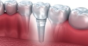 Dental implant parts